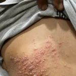 shingles adalah